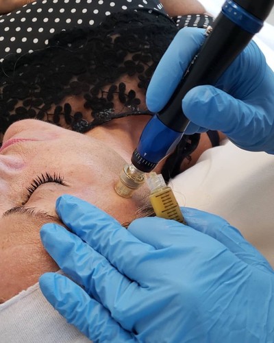 Lady lying on a treatment bed receiving a microneedling treatment