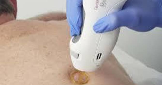 Laser Hair Removal