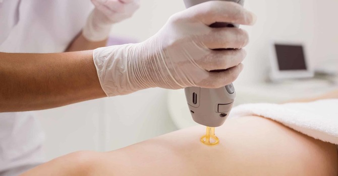 Laser Hair Removal: Myths vs. Facts image