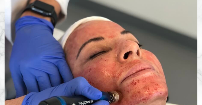 Transgender Surgery Preparation
