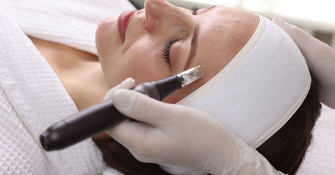 How Microneedling for Acne Scars Works (And Why It's So Effective)